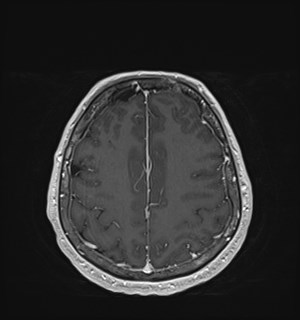Neurofibromatosis type 2 (Radiopaedia 79097-92049 Axial T1 C+ 151).jpg