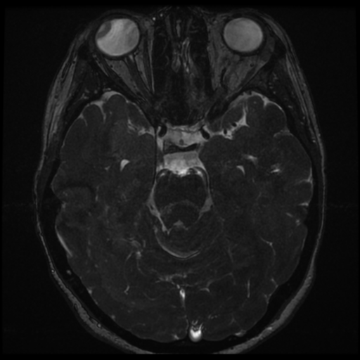 Neurofibromatosis type 2 - bilateral acoustic neuromata (Radiopaedia 40060-42566 Axial FIESTA 75).png
