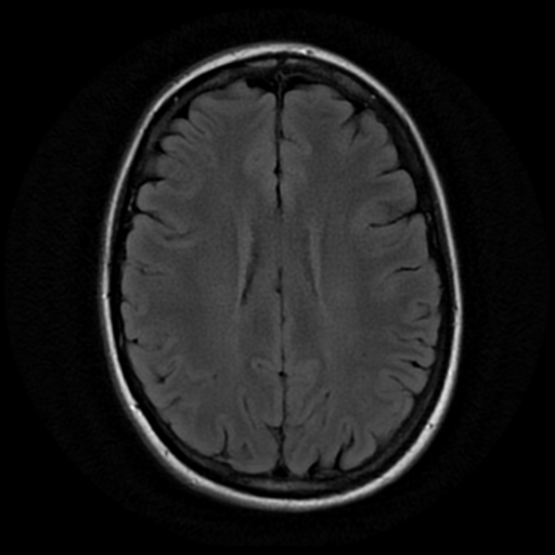 File:Neurofibromatosis type 2 - bilateral acoustic neuromata (Radiopaedia 40060-42566 Axial FLAIR 14).png
