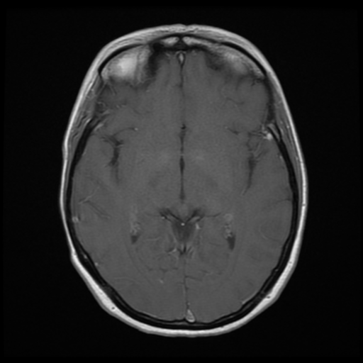 File:Neurofibromatosis type 2 - bilateral acoustic neuromata (Radiopaedia 40060-42566 Axial T1 C+ 10).png
