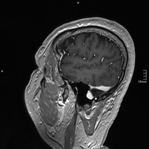 Neurosarcoidosis - involvement of the mesial temporal lobes (Radiopaedia 67429-76820 Sagittal T1 C+ 139).jpg