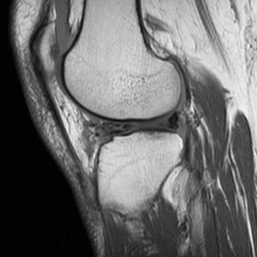 File:Non-displaced patella fracture (Radiopaedia 15932-15582 Sagittal T1 14).jpg