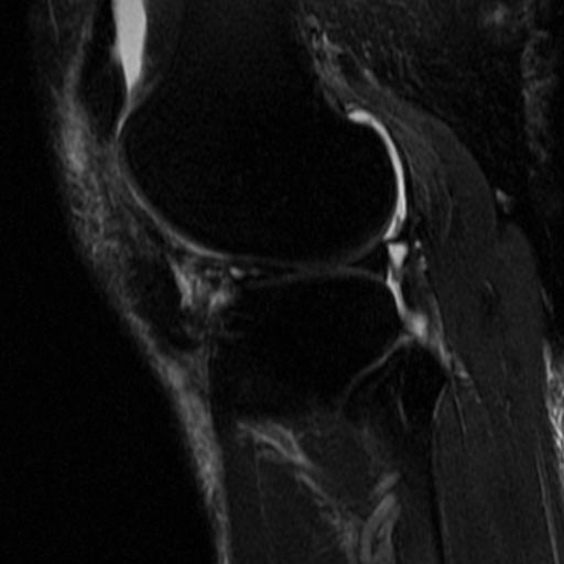 File:Non-displaced patella fracture (Radiopaedia 15932-15582 Sagittal T2 fat sat 14).jpg