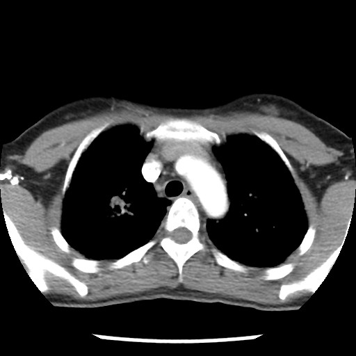 File:Non-small cell lung cancer with miliary metastases (Radiopaedia 23995-24193 A 15).jpg