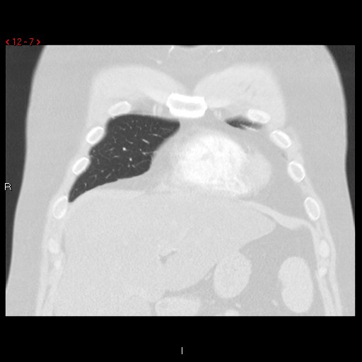 File:Non-specific interstitial pneumonitis (Radiopaedia 27044-27222 Coronal lung window 7).jpg