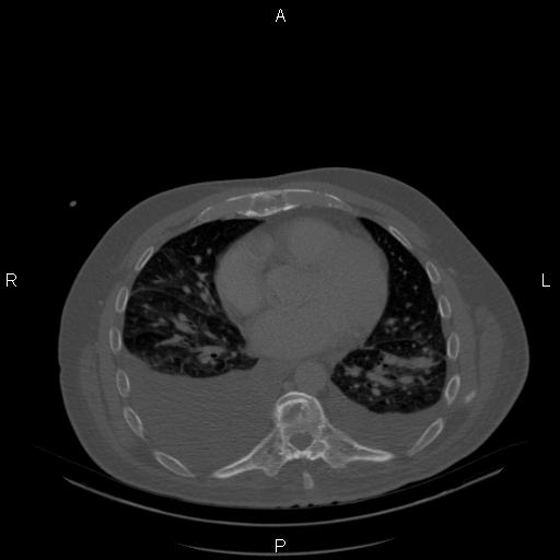 Non Hodgkin lymphoma in a patient with ankylosing spondylitis (Radiopaedia 84323-99624 Axial bone window 18).jpg