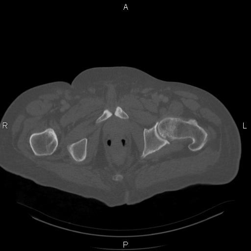 Non Hodgkin lymphoma in a patient with ankylosing spondylitis (Radiopaedia 84323-99624 Axial bone window 66).jpg