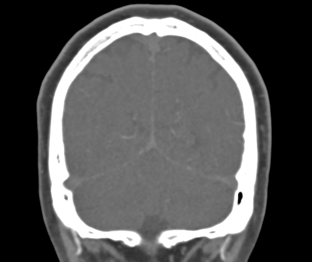 File:Normal CTA head (Radiopaedia 40801-43464 B 75).png