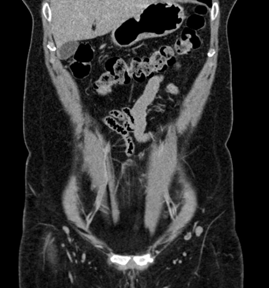 Normal CT intravenous urogram (Radiopaedia 39444-41759 A 199).jpg