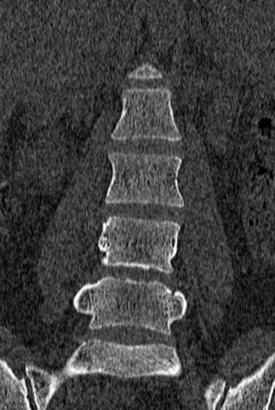 Normal CT lumbar spine (Radiopaedia 53981-60118 Coronal bone window 22).jpg