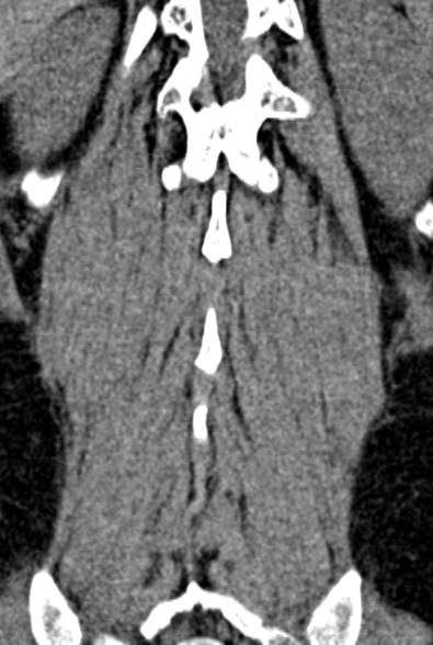 Normal CT lumbar spine (Radiopaedia 53981-60118 F 83).jpg