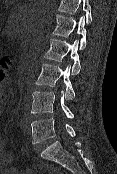 File:Normal CT lumbar spine (Radiopaedia 53981-60118 Sagittal bone window 41).jpg