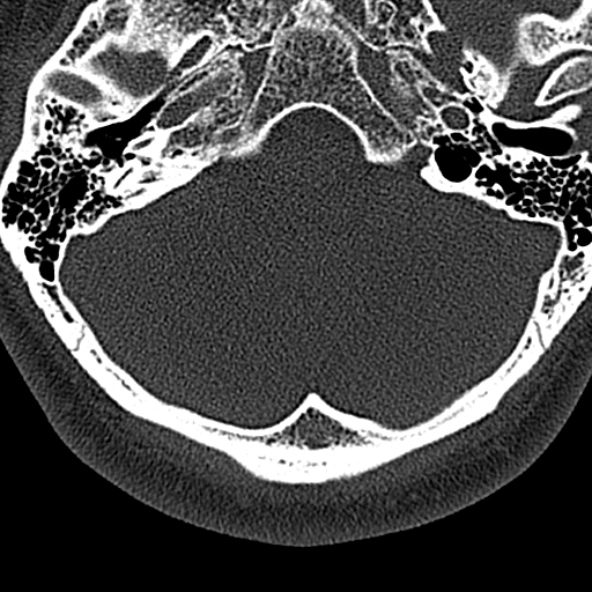 File:Normal CT of the cervical spine (Radiopaedia 53322-59305 Axial bone window 13).jpg