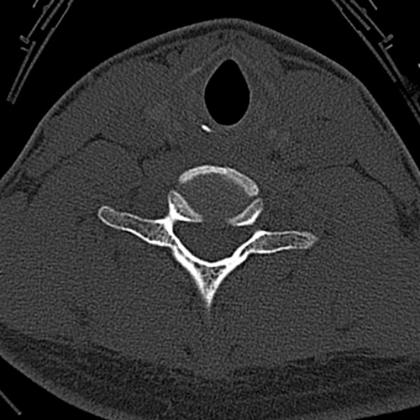 File:Normal CT of the cervical spine (Radiopaedia 53322-59305 Axial bone window 197).jpg
