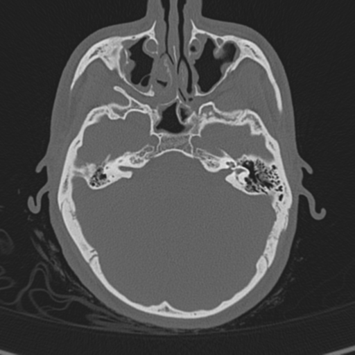 Normal CT skull (Radiopaedia 40798-43459 A 44).png