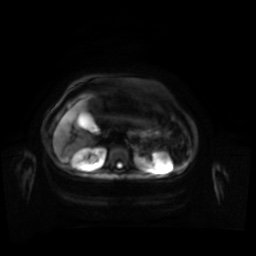 Normal MRI abdomen in pregnancy (Radiopaedia 88001-104541 Axial DWI 82).jpg