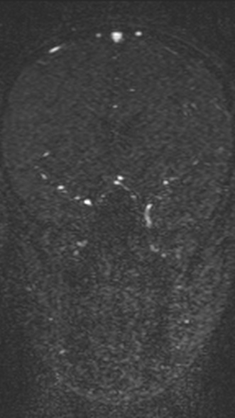 Normal MRI brain with MRV- teenager (Radiopaedia 49425-54553 Coronal MRV 105).jpg