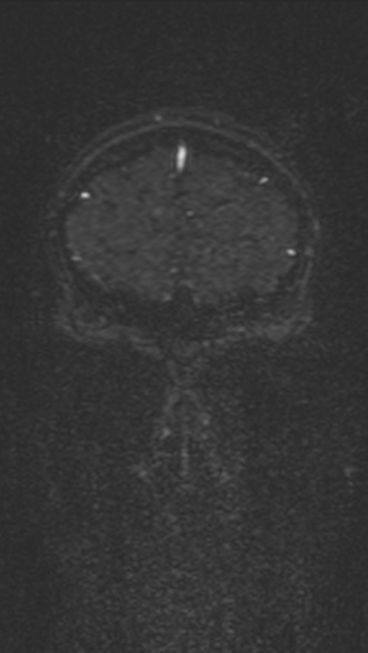 Normal MRI brain with MRV- teenager (Radiopaedia 49425-54553 Coronal MRV 47).jpg