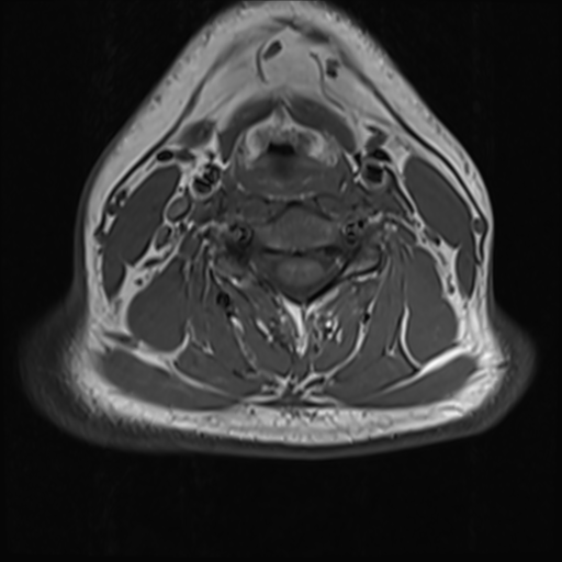 File:Normal MRI cervical spine (infection protocol) (Radiopaedia 53916-60039 Axial 28).png