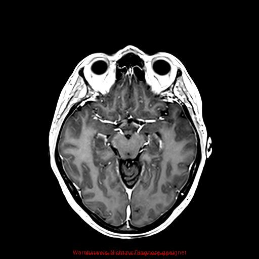 Normal adult brain MRI (non-enhanced and contrast-enhanced) (Radiopaedia 75262-86379 Axial T1 C+ 92).jpg