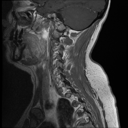 File:Normal cervical and thoracic spine MRI (Radiopaedia 35630-37156 Sagittal T1 C+ 11).png