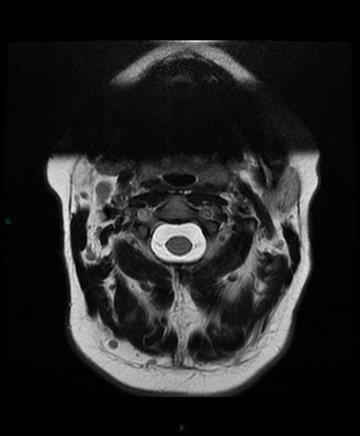 Normal cervical spine MRI (Radiopaedia 80146-93454 Axial T2 4).jpg