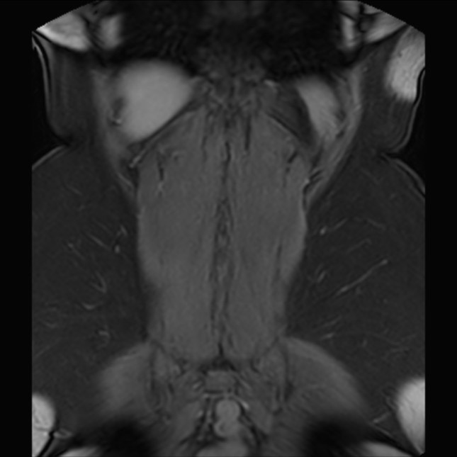 Normal liver MRI with Gadolinium (Radiopaedia 58913-66163 P 75).jpg