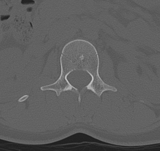 File:Normal lumbar spine CT (Radiopaedia 46533-50986 Axial bone window 11).png