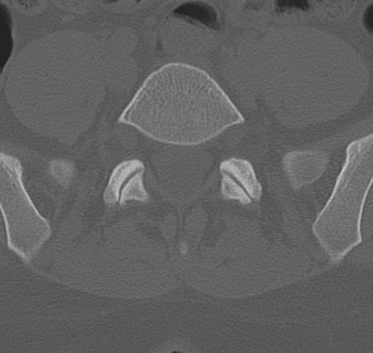 File:Normal lumbar spine CT (Radiopaedia 46533-50986 Axial bone window 62).png