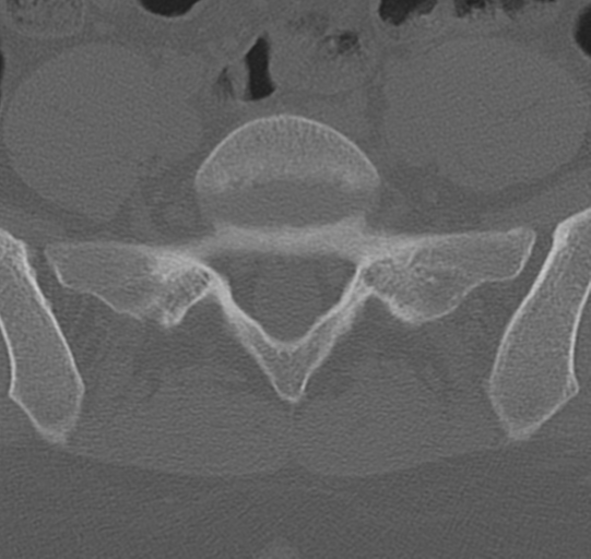 File:Normal lumbar spine CT (Radiopaedia 46533-50986 Axial bone window 65).png