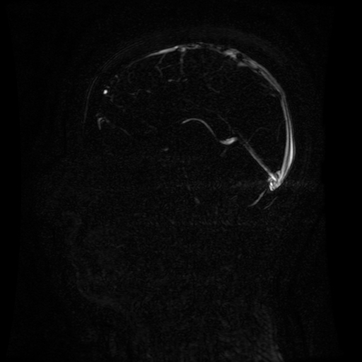 Normal noncontrast MR venography (Radiopaedia 87578-103957 A 89).jpg