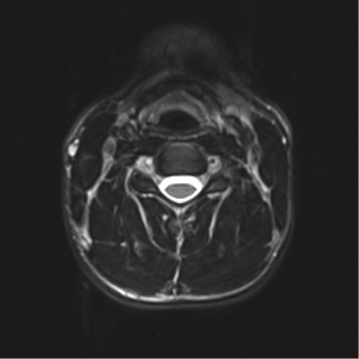 Normal trauma cervical spine (Radiopaedia 41017-43762 D 21).png