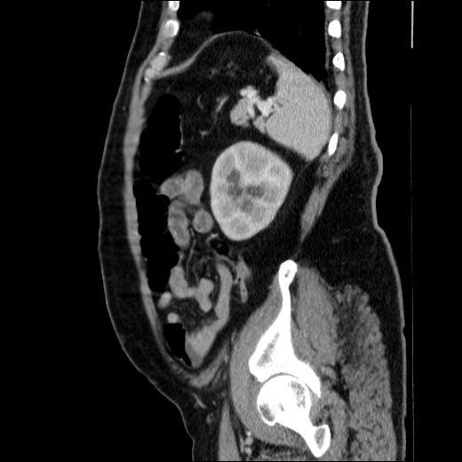 Obstructing ureteric calculus (Radiopaedia 49281-54373 C 25).jpg