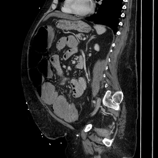 Obstructive colonic diverticular stricture (Radiopaedia 81085-94675 C 145).jpg