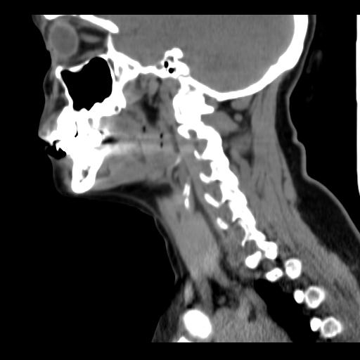 File:Obstructive sleep apnea (CT evaluation) (Radiopaedia 24304-24582 C 47).jpg