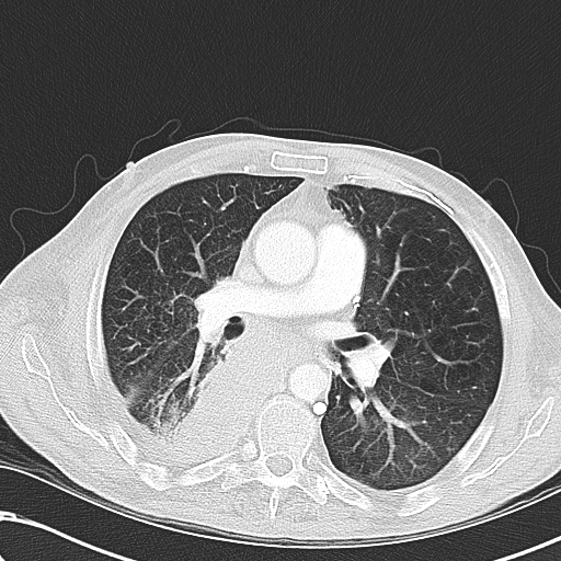 File:Obstructive superior vena cava tumor thrombus (Radiopaedia 28046-28306 Axial lung window 26).jpg