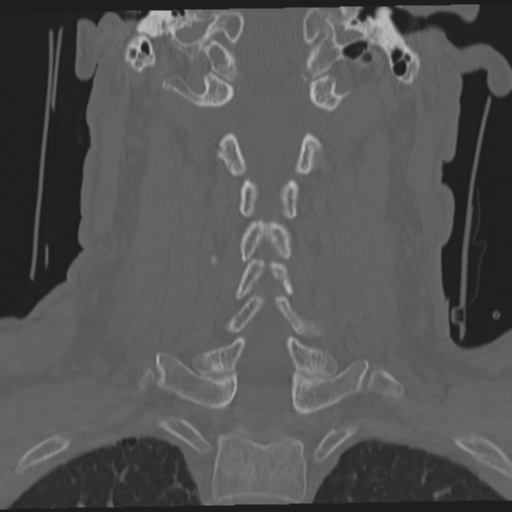 File:Occipital condyle fracture (Radiopaedia 33467-34517 Coronal bone window 38).png