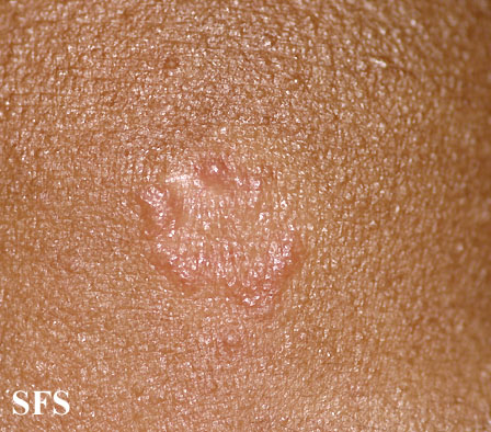 File:Sarcoidosis (Dermatology Atlas 9).jpg