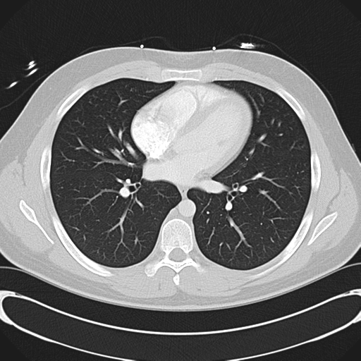 'Bovine' aortic arch (Radiopaedia 33554-34637 Axial lung window 35).png