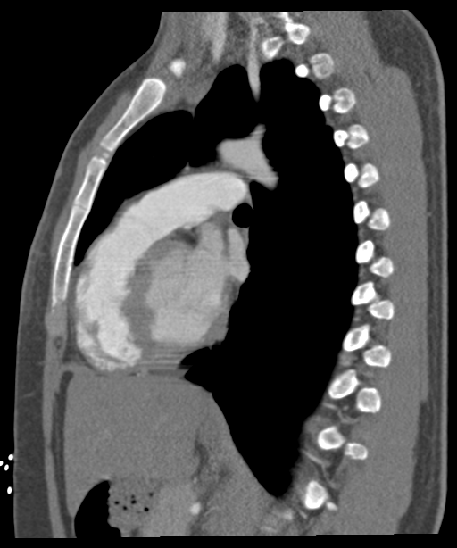 'Bovine' aortic arch (Radiopaedia 33554-34637 B 31).png