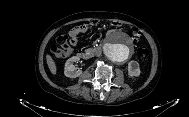 File:Abdominal aortic aneurysm (Radiopaedia 20461).jpg