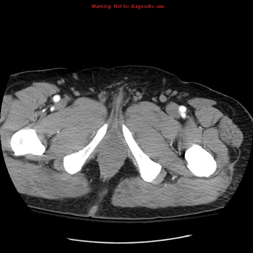 Abdominal aortic aneurysm (Radiopaedia 8190-9038 Axial C+ arterial phase 90).jpg