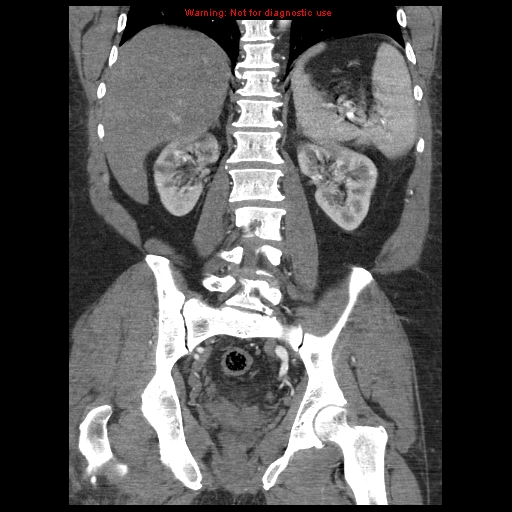 Abdominal aortic aneurysm (Radiopaedia 8190-9038 Coronal C+ arterial phase 87).jpg
