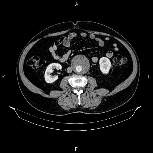 File:Abdominal aortic aneurysm (Radiopaedia 83094-97462 Axial renal cortical phase 105).jpg