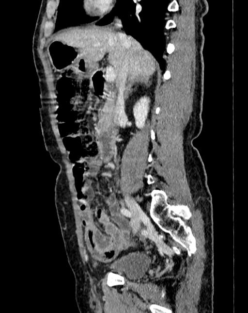 Abdominal aortic aneurysm (Radiopaedia 83581-98689 Sagittal C+ portal venous phase 22).jpg