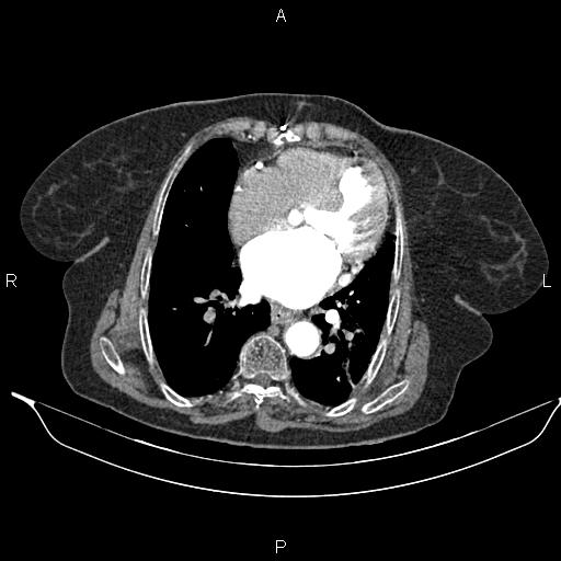 File:Abdominal aortic aneurysm (Radiopaedia 85063-100606 Axial C+ arterial phase 21).jpg