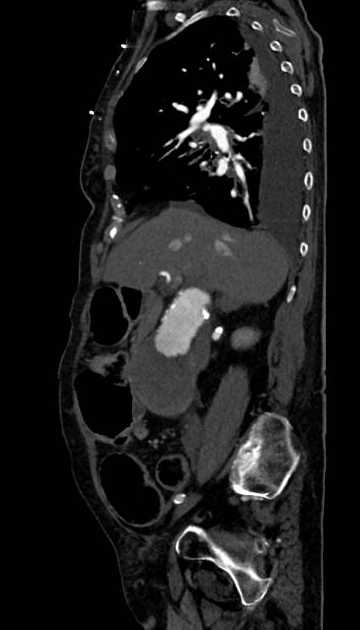 Abdominal aortic aneurysm with thrombus fissuration (Radiopaedia 73192-83919 Sagittal C+ arterial phase 95).jpg