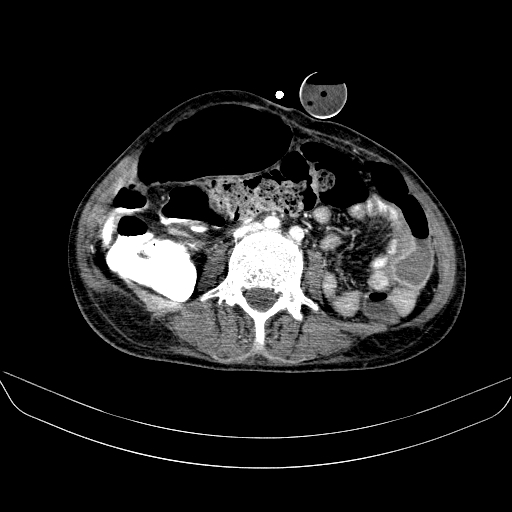 File:Abdominal collection due to previous cecal perforation (Radiopaedia 80831-94320 Axial C+ portal venous phase 117).jpg