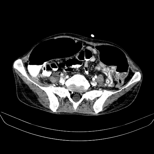 File:Abdominal collection due to previous cecal perforation (Radiopaedia 80831-94320 Axial C+ portal venous phase 144).jpg