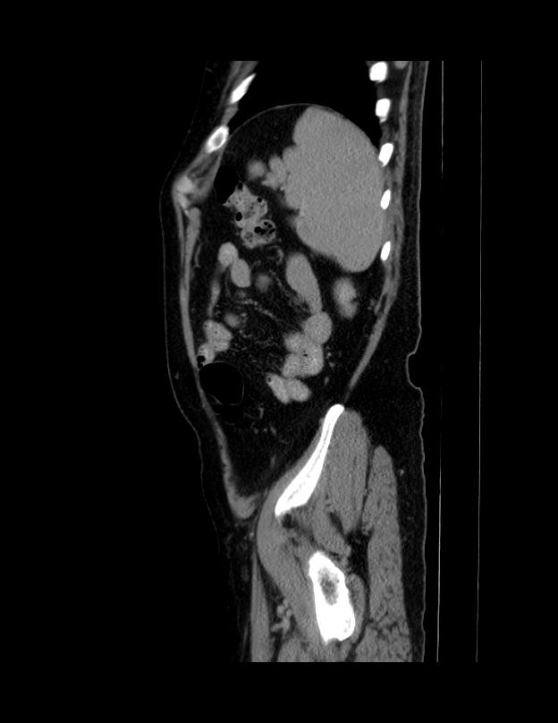 Abdominal lymphoma - with sandwich sign (Radiopaedia 53486-59492 Sagittal C+ portal venous phase 11).jpg